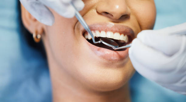 Best Knocked-Out Tooth (Avulsed Tooth) Treatment in Riverton, WY